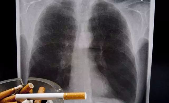 肺癌狡猾至極，會用6個表現來「迷惑」你，不知不覺！ 健康 第3張