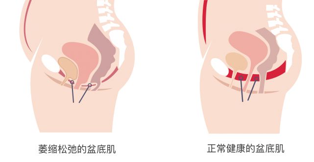 【产后康复】盆底恢复——产后宝妈的必修课，再不做就来不及了！