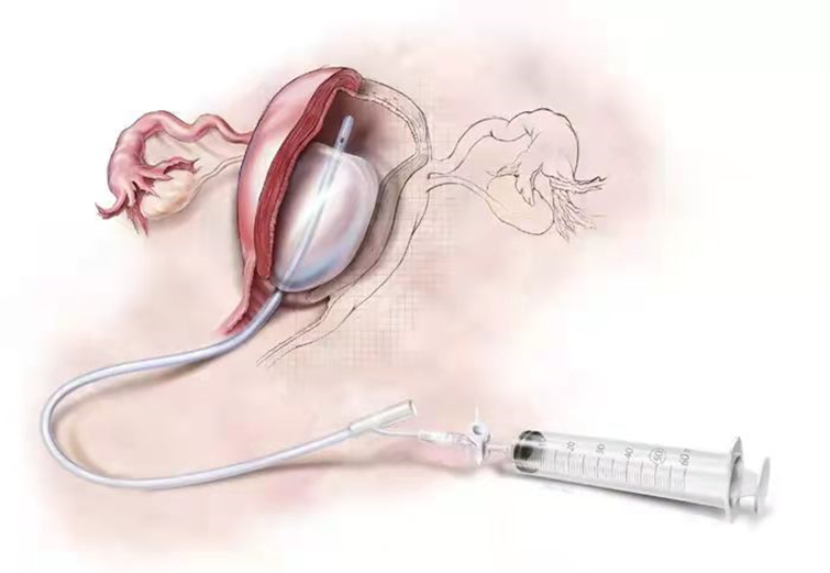 妇科填塞器怎么拿出【小球囊大作用】大埔县人民医院产科成功开展宫腔止血球囊填塞术，高效抢救产后出血_https://www.jmylbn.com_新闻资讯_第5张