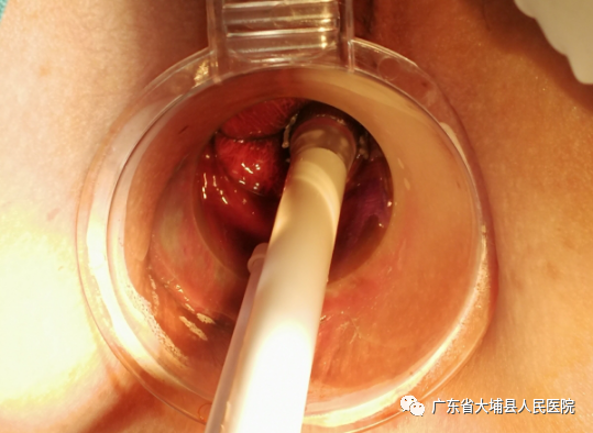 痔疮套扎吻合器怎么用【治痔疮，新技术】普外科成功开展“自动弹力线痔疮套扎术”（RPH术）_https://www.jmylbn.com_新闻资讯_第7张