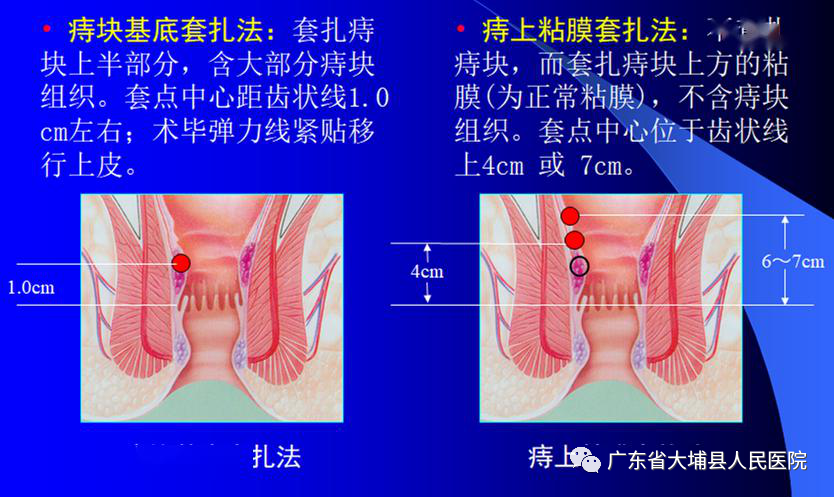 痔疮套扎吻合器怎么用【治痔疮，新技术】普外科成功开展“自动弹力线痔疮套扎术”（RPH术）_https://www.jmylbn.com_新闻资讯_第14张
