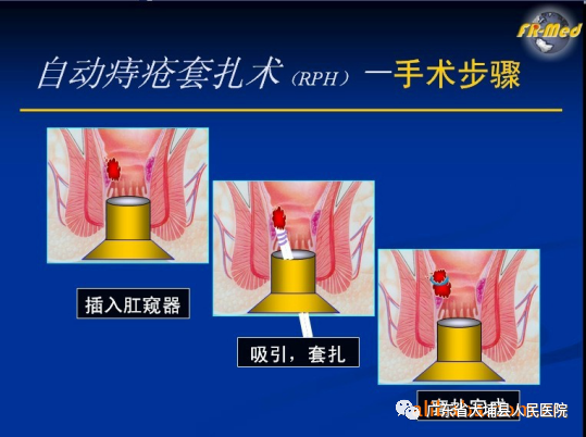 痔疮套扎吻合器怎么用【治痔疮，新技术】普外科成功开展“自动弹力线痔疮套扎术”（RPH术）_https://www.jmylbn.com_新闻资讯_第13张