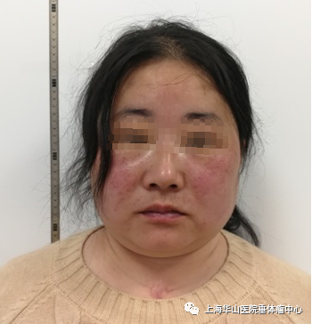 向心性肥胖,紫纹,满月脸,痤疮以及骨质疏松,这些典型