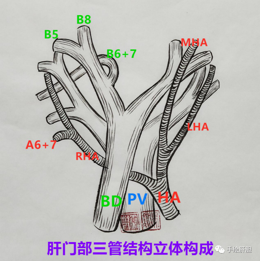 普外科腹腔鏡篇肝門部膽管癌