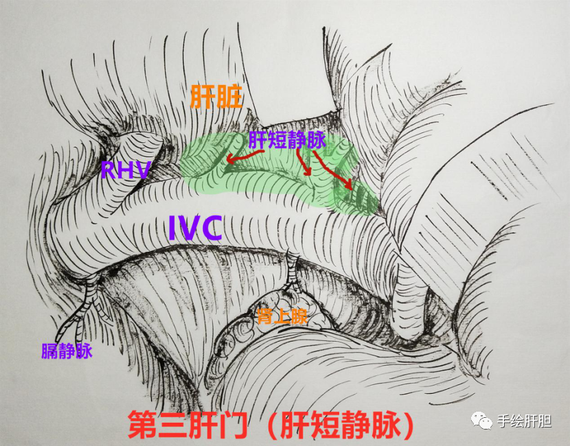 【普外科腹腔镜篇】肝门部胆管癌 - 新闻动态