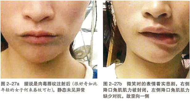 微整形注射并发症 下面部注射偏差 微整形学 微信公众号文章阅读 Wemp