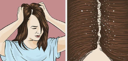 头皮痒有疙瘩越挠越痒？头皮癣的症状及治疗方法告别尴尬雪花头！