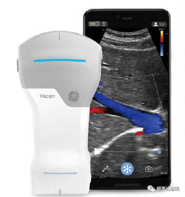 索诺星超声怎么样掌上超声新时代，来看看哪些是主流？_https://www.jmylbn.com_新闻资讯_第16张