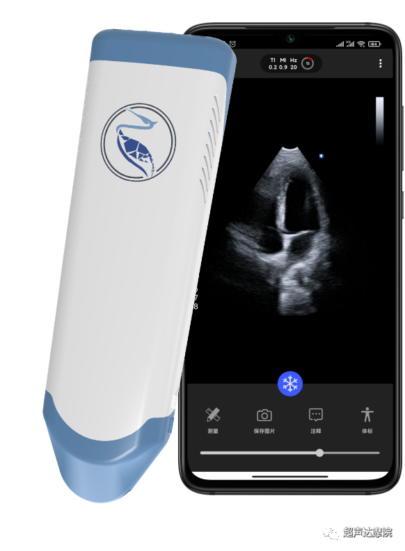 索诺星超声怎么样掌上超声新时代，来看看哪些是主流？_https://www.jmylbn.com_新闻资讯_第5张