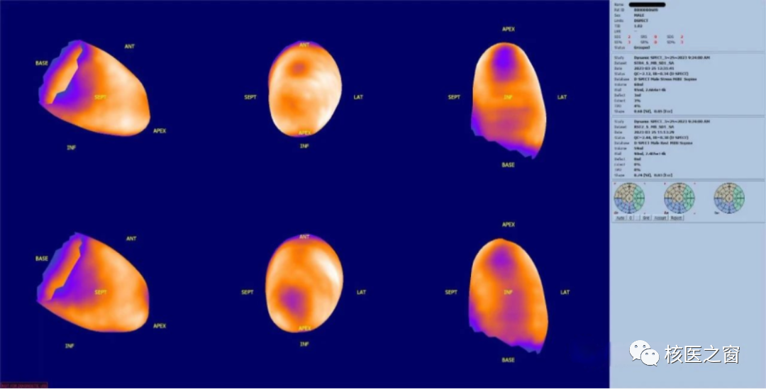 d-spect怎么检查医院动态 ｜ 甘肃省人民医院核医学科在省内率先开展D-SPECT瑞加诺生药物负荷心肌灌注显像MPI_https://www.jmylbn.com_新闻资讯_第9张