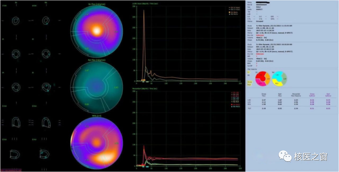 d-spect怎么检查医院动态 ｜ 甘肃省人民医院核医学科在省内率先开展D-SPECT瑞加诺生药物负荷心肌灌注显像MPI_https://www.jmylbn.com_新闻资讯_第8张