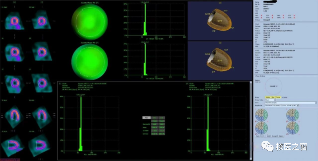 d-spect怎么检查医院动态 ｜ 甘肃省人民医院核医学科在省内率先开展D-SPECT瑞加诺生药物负荷心肌灌注显像MPI_https://www.jmylbn.com_新闻资讯_第10张