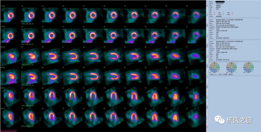 d-spect怎么检查医院动态 ｜ 甘肃省人民医院核医学科在省内率先开展D-SPECT瑞加诺生药物负荷心肌灌注显像MPI_https://www.jmylbn.com_新闻资讯_第4张