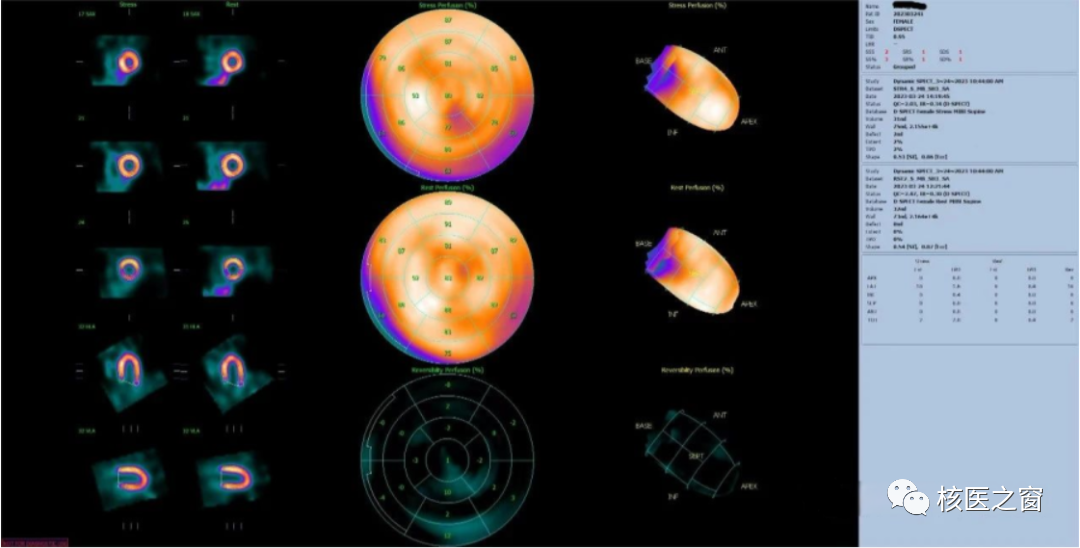 d-spect怎么检查医院动态 ｜ 甘肃省人民医院核医学科在省内率先开展D-SPECT瑞加诺生药物负荷心肌灌注显像MPI_https://www.jmylbn.com_新闻资讯_第6张