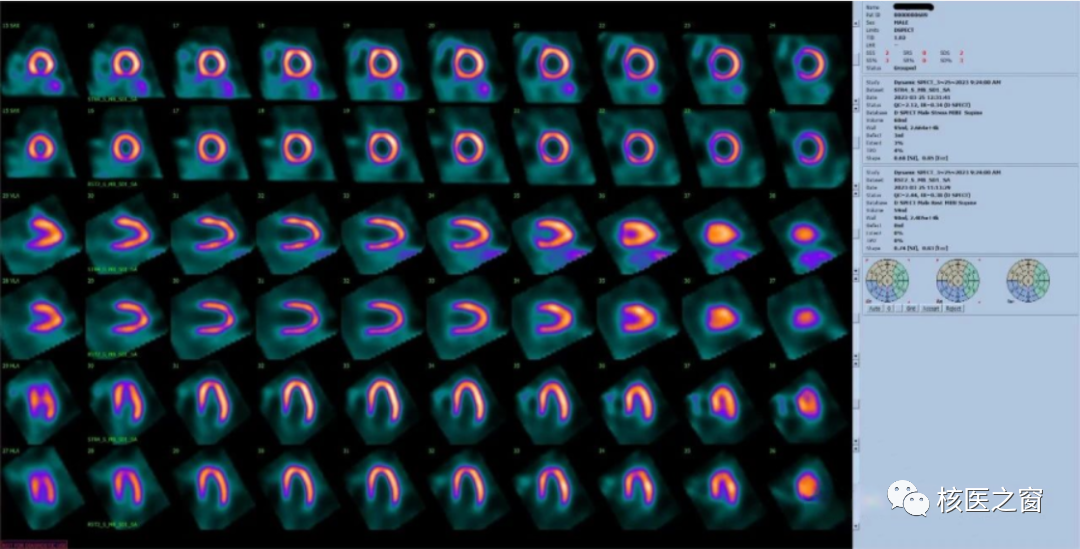d-spect怎么检查医院动态 ｜ 甘肃省人民医院核医学科在省内率先开展D-SPECT瑞加诺生药物负荷心肌灌注显像MPI_https://www.jmylbn.com_新闻资讯_第7张