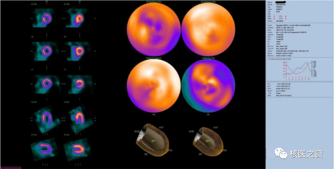 d-spect怎么检查医院动态 ｜ 甘肃省人民医院核医学科在省内率先开展D-SPECT瑞加诺生药物负荷心肌灌注显像MPI_https://www.jmylbn.com_新闻资讯_第5张
