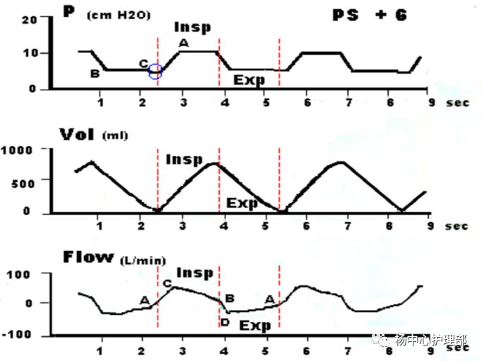 什么是 bipap【科普】呼吸累了吗？---Bipap帮你忙！_https://www.jmylbn.com_新闻资讯_第4张