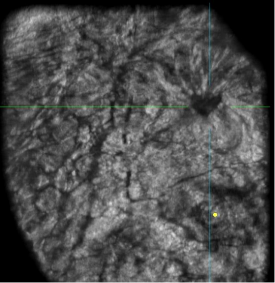 什么是超声容积探头乳腺疾病筛查新武器——ABUS自动乳腺全容积超声扫描系统_https://www.jmylbn.com_新闻资讯_第3张