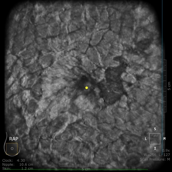 什么是超声容积探头乳腺疾病筛查新武器——ABUS自动乳腺全容积超声扫描系统_https://www.jmylbn.com_新闻资讯_第5张