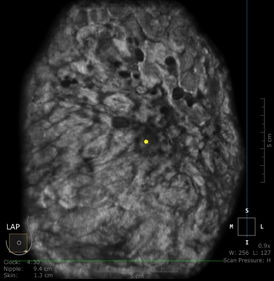 什么是超声容积探头乳腺疾病筛查新武器——ABUS自动乳腺全容积超声扫描系统_https://www.jmylbn.com_新闻资讯_第4张