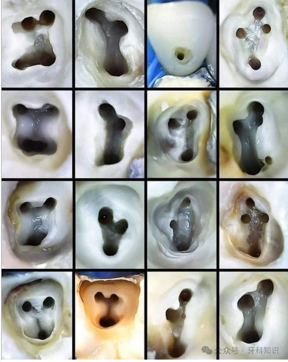 全口开髓标准图，值得收藏！