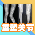 重塑关节，恢复自由人生！ 多位膝关节严重畸形患者在这里治愈！