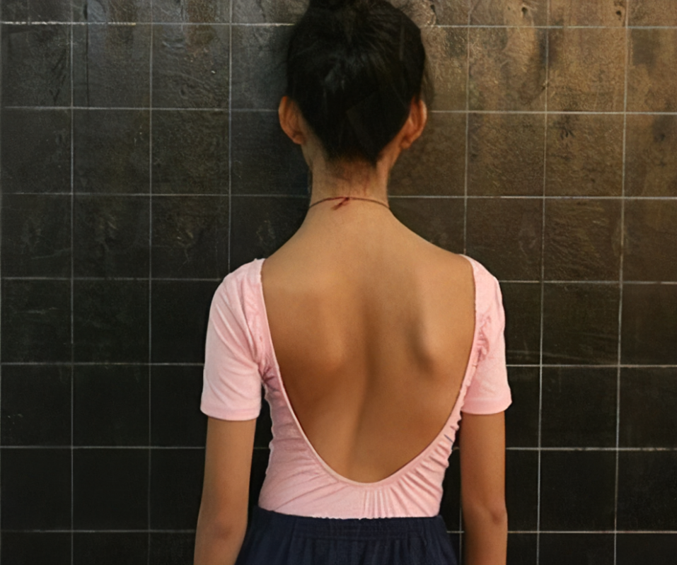 【脊柱侧弯康复案例】舞蹈少女的矫治之路
