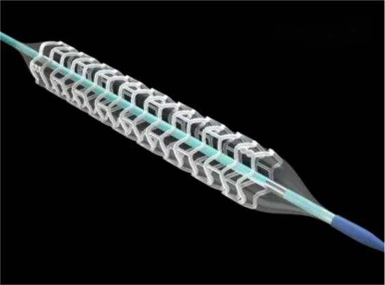 乐普心脏支架怎么样行业研究｜一文了解冠脉支架的前世今生_https://www.jmylbn.com_新闻资讯_第6张