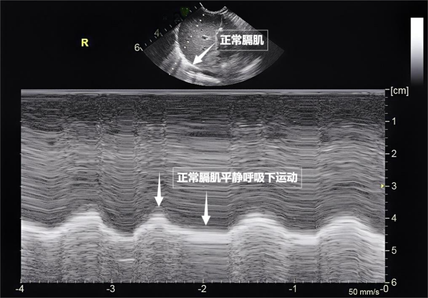 图为正常膈肌超声表现