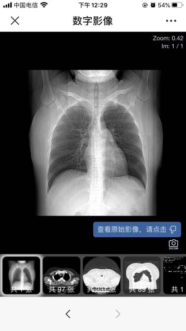 为什么x光片用胶片将X光片“装进”手机里_https://www.jmylbn.com_新闻资讯_第4张