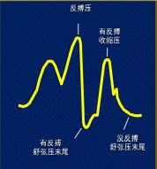 clearcuff加压袋为什么主动脉内球囊反搏（IABP），看这一篇就够了！_https://www.jmylbn.com_新闻资讯_第9张