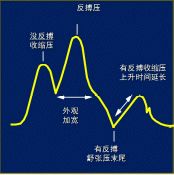 clearcuff加压袋为什么主动脉内球囊反搏（IABP），看这一篇就够了！_https://www.jmylbn.com_新闻资讯_第10张