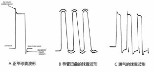 clearcuff加压袋为什么主动脉内球囊反搏（IABP），看这一篇就够了！_https://www.jmylbn.com_新闻资讯_第5张