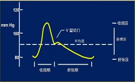 clearcuff加压袋为什么主动脉内球囊反搏（IABP），看这一篇就够了！_https://www.jmylbn.com_新闻资讯_第3张
