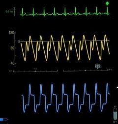 clearcuff加压袋为什么主动脉内球囊反搏（IABP），看这一篇就够了！_https://www.jmylbn.com_新闻资讯_第2张