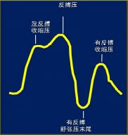 clearcuff加压袋为什么主动脉内球囊反搏（IABP），看这一篇就够了！_https://www.jmylbn.com_新闻资讯_第7张