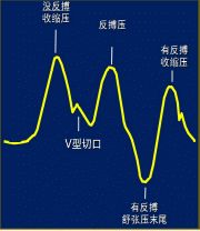 clearcuff加压袋为什么主动脉内球囊反搏（IABP），看这一篇就够了！_https://www.jmylbn.com_新闻资讯_第8张