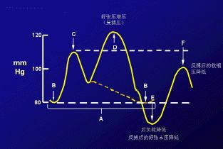 clearcuff加压袋为什么主动脉内球囊反搏（IABP），看这一篇就够了！_https://www.jmylbn.com_新闻资讯_第6张