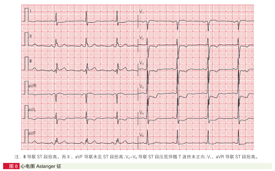 【共识整理】ST段抬高型心肌梗死和6个等危表现的心电图和报告规范