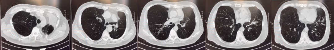 abp在医学是什么意思美例新声病例分享 ｜ 复发活动性变应性支气管肺曲霉病（ABPA）咳嗽患者诊治经验分享_https://www.jmylbn.com_新闻资讯_第8张