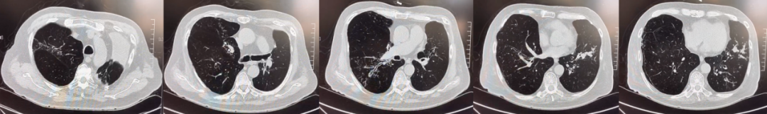 abp在医学是什么意思美例新声病例分享 ｜ 复发活动性变应性支气管肺曲霉病（ABPA）咳嗽患者诊治经验分享_https://www.jmylbn.com_新闻资讯_第7张