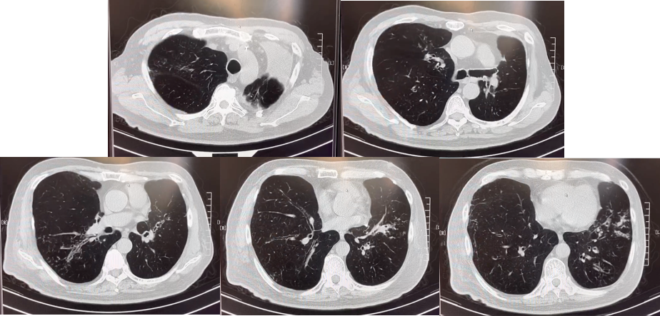 abp在医学是什么意思美例新声病例分享 ｜ 复发活动性变应性支气管肺曲霉病（ABPA）咳嗽患者诊治经验分享_https://www.jmylbn.com_新闻资讯_第11张