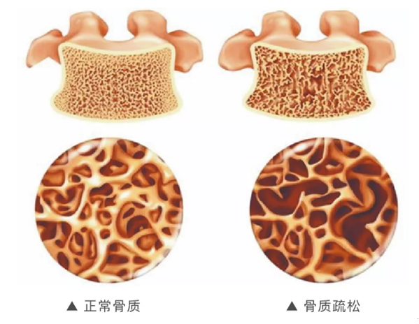双能x骨密度检测仪为什么非得输入体重身高【医疗设备专题（八）】“双能X线全身骨密度检测仪”——骨质疏松患者的福音_https://www.jmylbn.com_新闻资讯_第4张