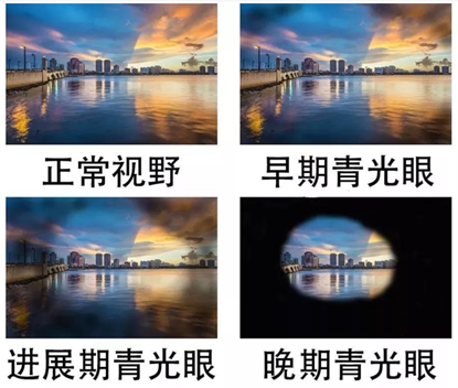 怎么装青光眼眼睛装“阀门” ，难治性青光眼不“难治”！_https://www.jmylbn.com_新闻资讯_第7张