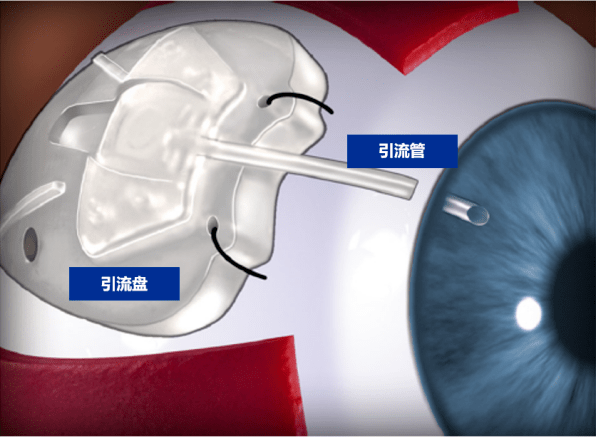 怎么装青光眼眼睛装“阀门” ，难治性青光眼不“难治”！_https://www.jmylbn.com_新闻资讯_第15张