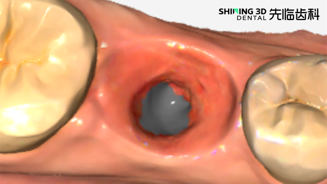 牙龈数据范围足够