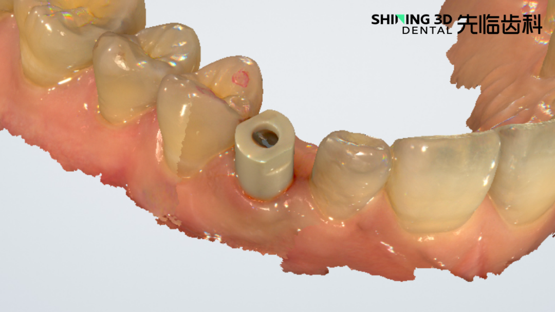 邻接接触区采集完整