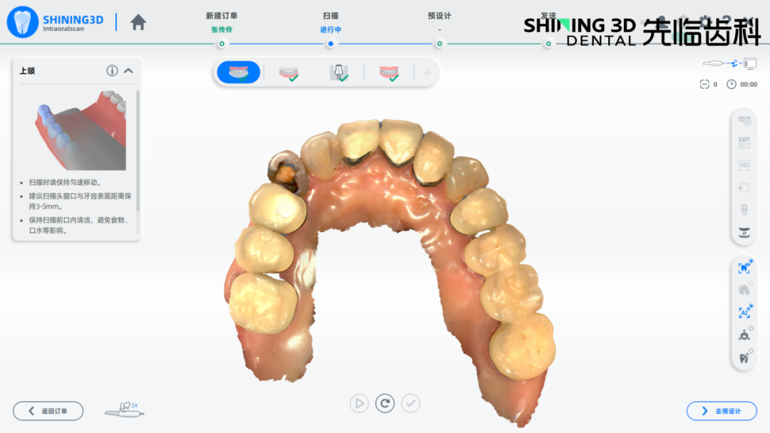 扫描杆未被牙龈覆盖