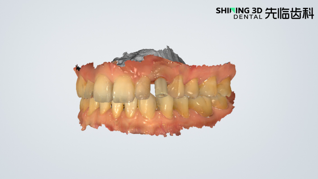 对颌牙的颌面数据完整