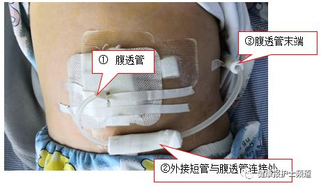 为什么要加热输血儿科护士发明家又有创新了！小发明，大作用！快来围观呀！_https://www.jmylbn.com_新闻资讯_第4张